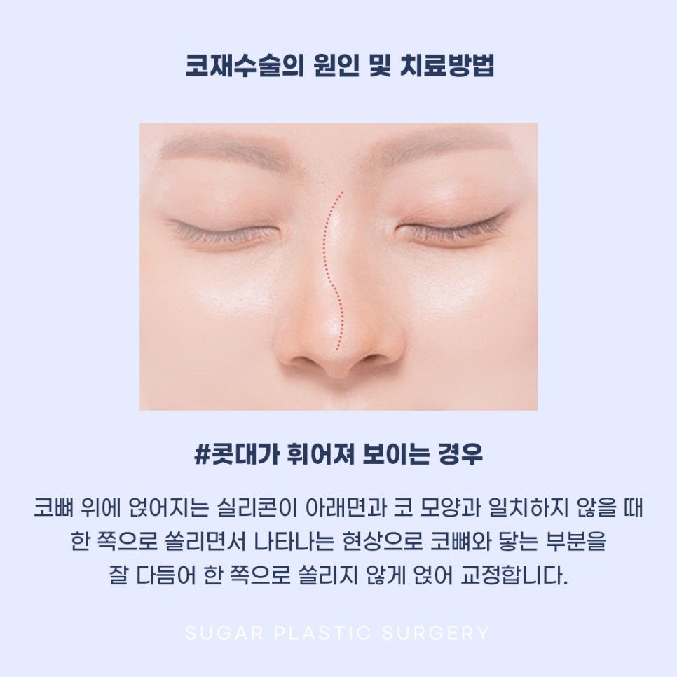코재수술 그 유형과 해결방법은? 관련 이미지 8