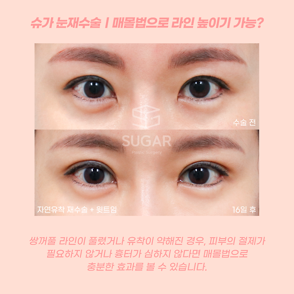 눈재수술 라인높이는 방법 관련 이미지 6