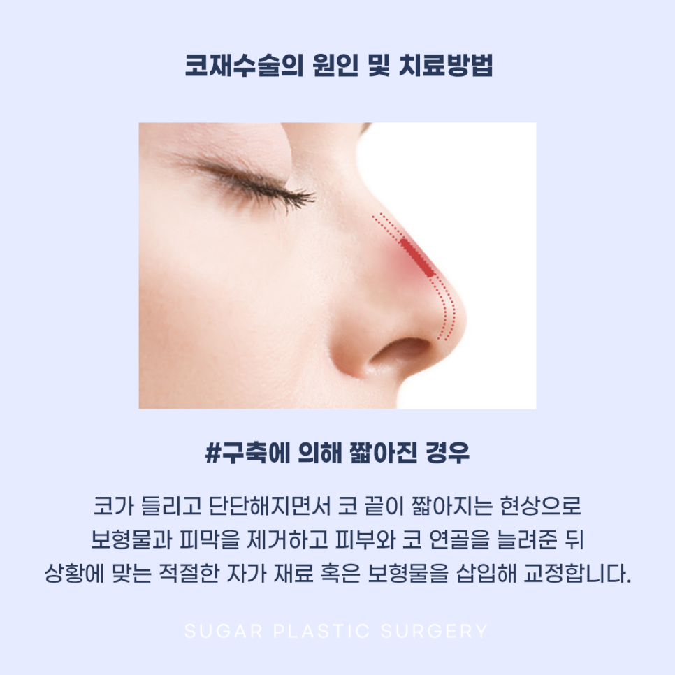 코재수술 그 유형과 해결방법은? 관련 이미지 3