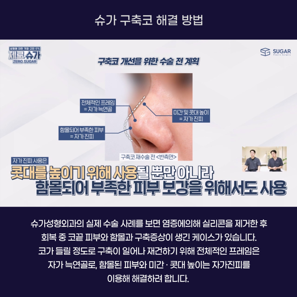 코재수술의 끝판왕, 구축코 케이스와 해결방법 관련 이미지 6