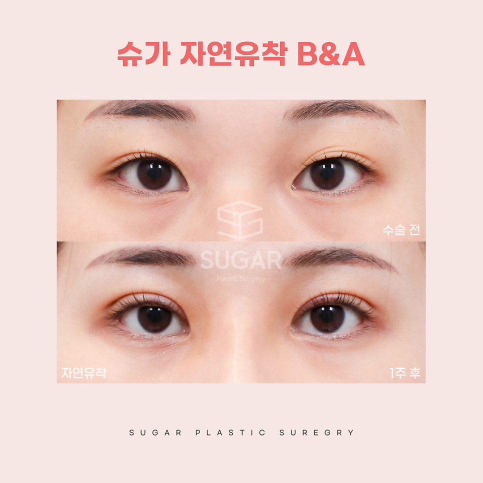 연예인쌍수라인으로 보는 쌍꺼풀라인 관련 이미지 10