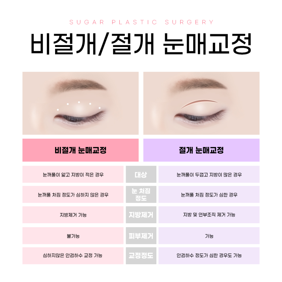 쌍꺼풀과 눈매교정의 차이점 관련 이미지 4