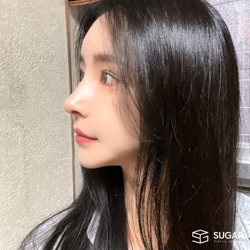 코성형부작용 어디까지 알아봤나요? 관련 이미지 6