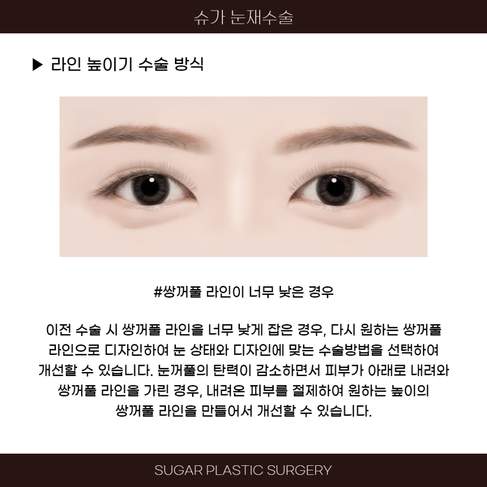 라인높이기 눈재수술 이것만은 알고가자 관련 이미지 4