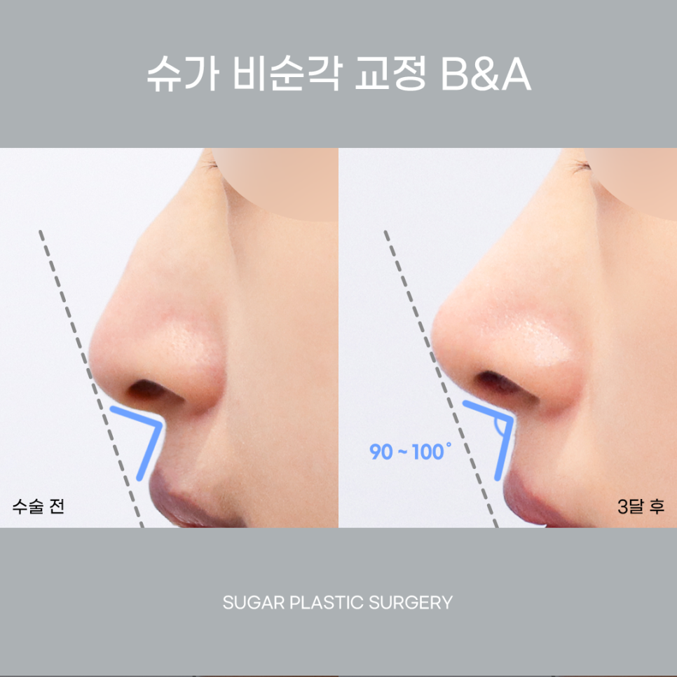 비주와 비순각교정 어떻게 할까? 관련 이미지 10