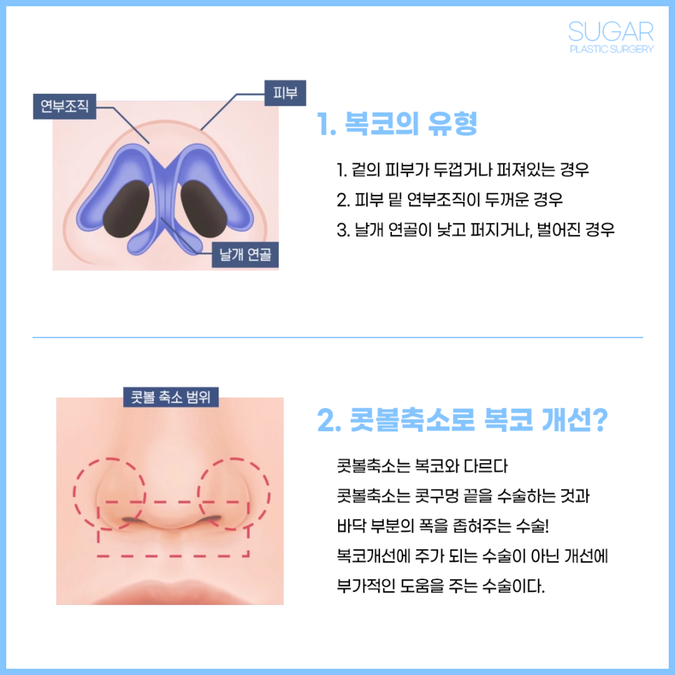 복코수술 유형에 따른 수술방법 관련 이미지 2