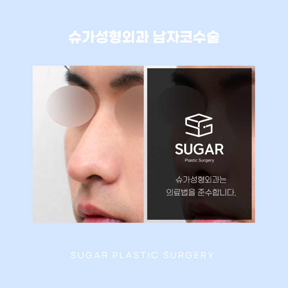 남자코수술 여자랑 어떻게 다를까 관련 이미지 10