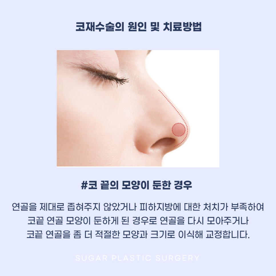 코재수술 그 유형과 해결방법은? 관련 이미지 5