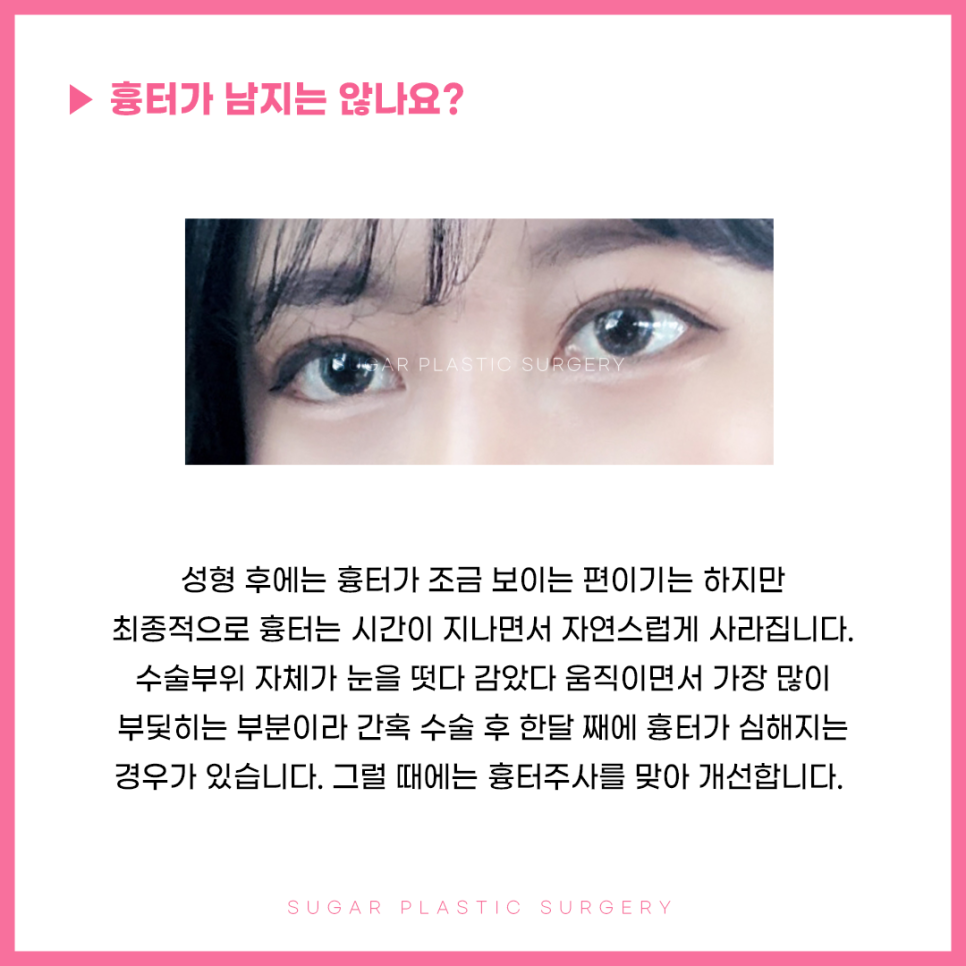 앞윗트임 어디까지 알아봤나요? 관련 이미지 5