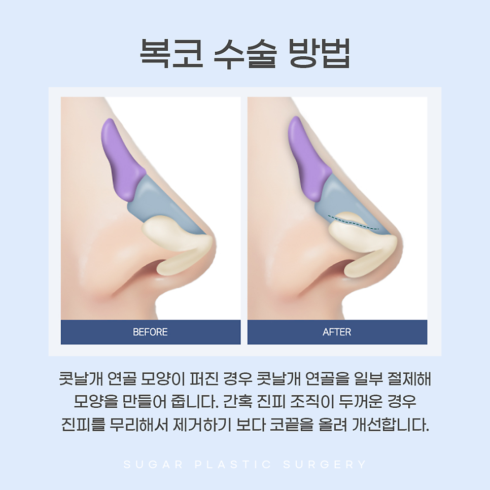 콧볼축소와 코끝성형을 같이 하는 이유는? 관련 이미지 10
