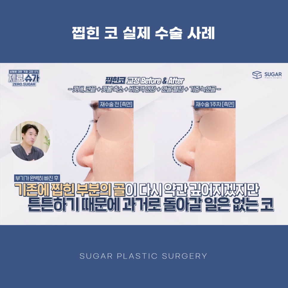 찝힌코 왜 생기는 걸까? 관련 이미지 15