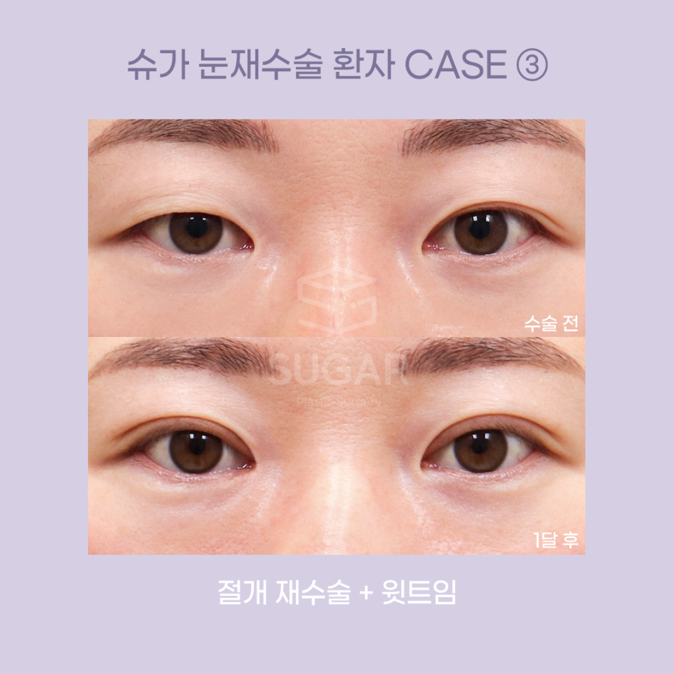 [슈가성형외과] 눈성형 실패하는 이유! 관련 이미지 9