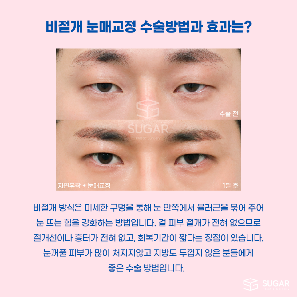 비절개눈매교정 VS 절개눈매교정 관련 이미지 9
