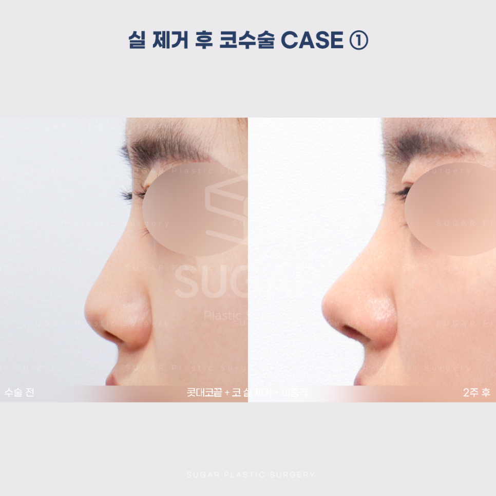 [슈가성형외과] 이런 코시술 하지마세요 관련 이미지 7