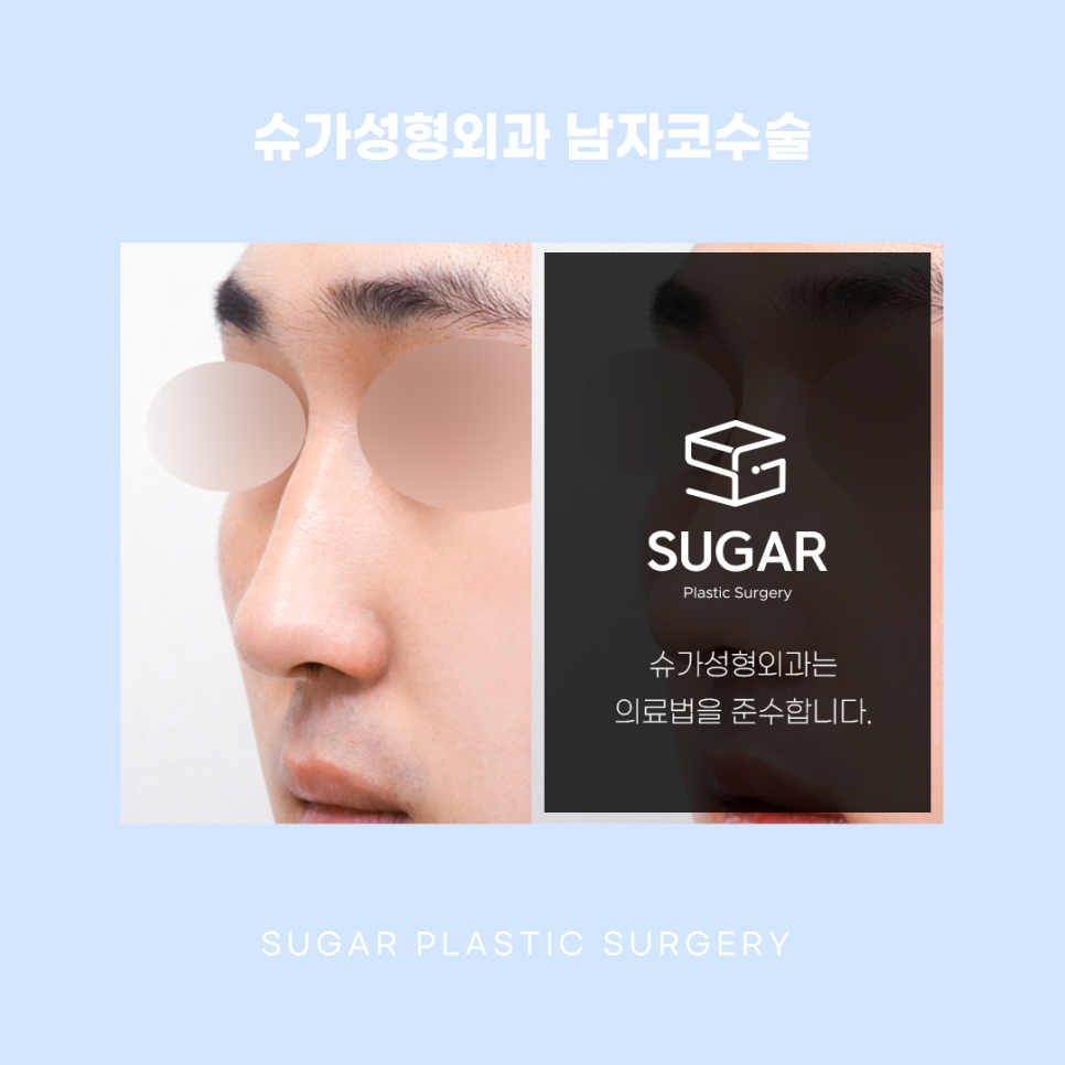 남자코수술 여자랑 어떻게 다를까 관련 이미지 8