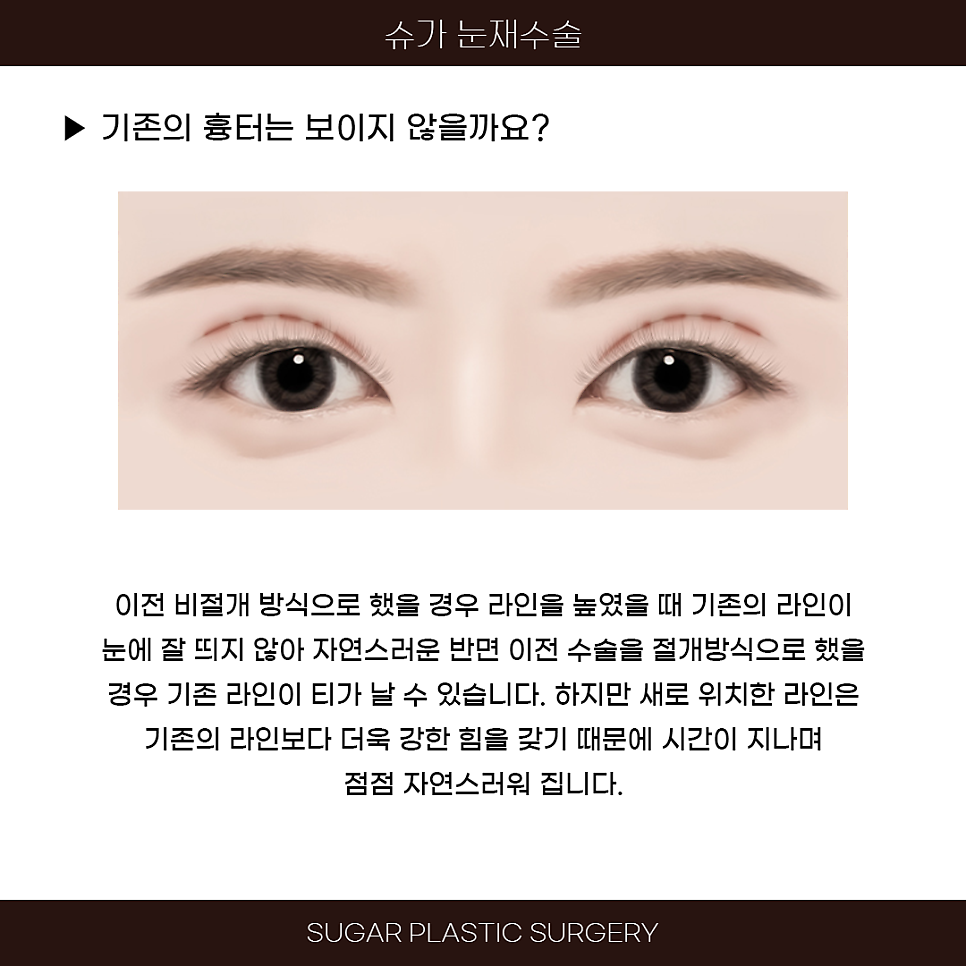 라인높이기 눈재수술 이것만은 알고가자 관련 이미지 6