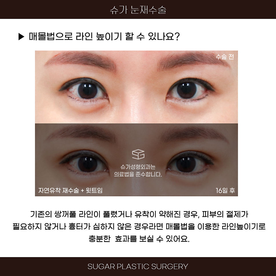 라인높이기 눈재수술 이것만은 알고가자 관련 이미지 7