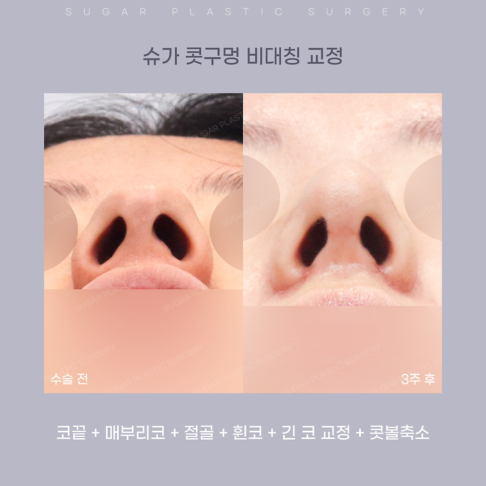 코 성형 후 콧구멍 짝짝이가 되었다?! 관련 이미지 6
