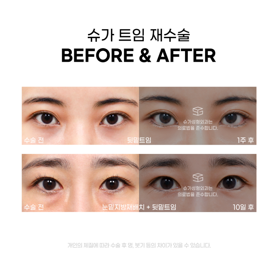 트임재수술 실패없이 하려면 관련 이미지 6