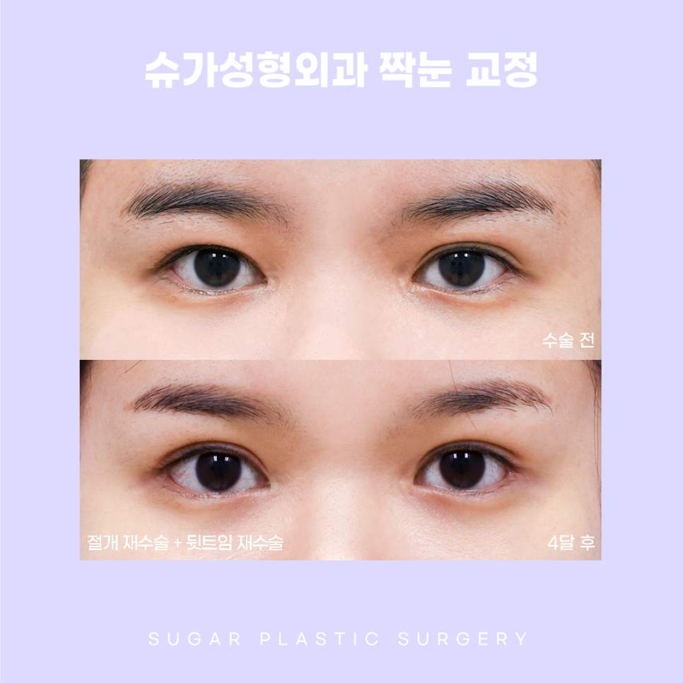 짝눈 교정 종류부터 해결까지 관련 이미지 11