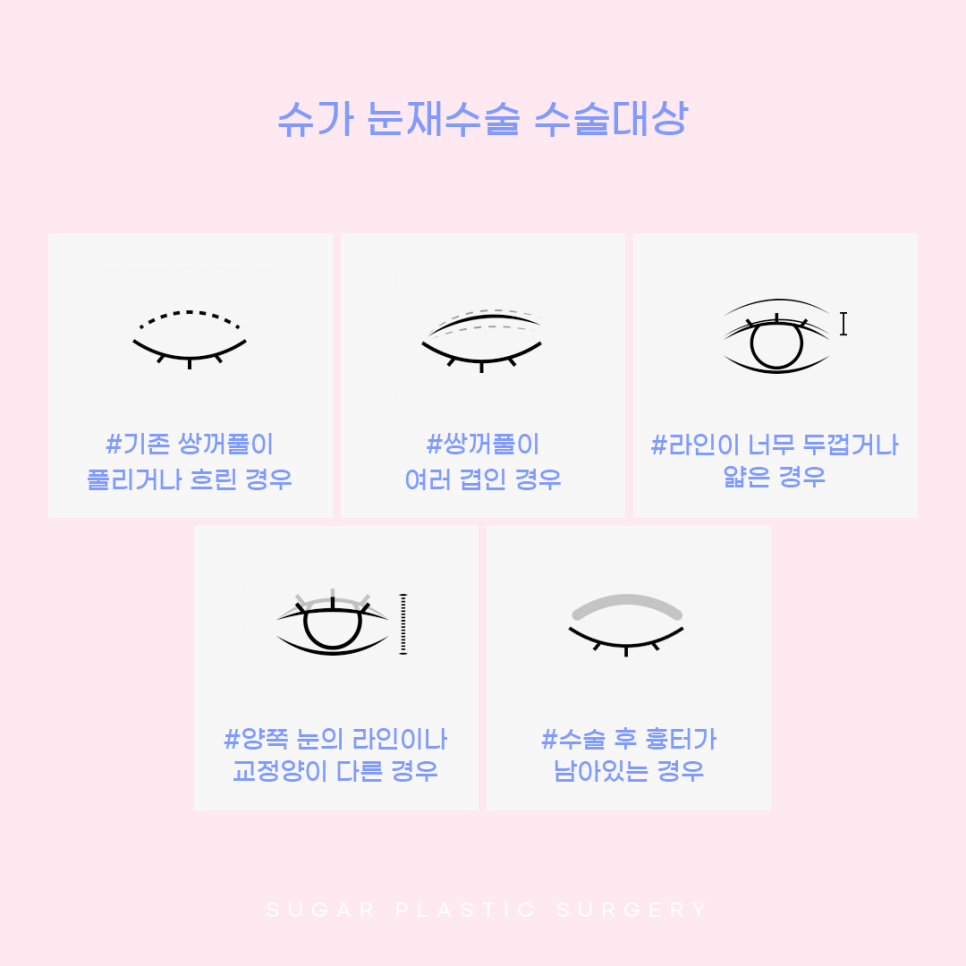 눈재수술 비절개로 가능할까? 관련 이미지 10