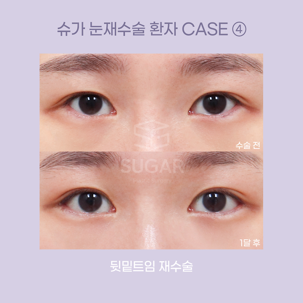 [슈가성형외과] 눈성형 실패하는 이유! 관련 이미지 10