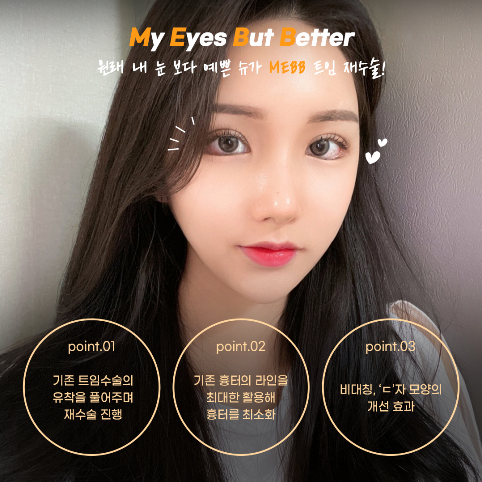 트임재수술 실패없이 하려면 관련 이미지 8