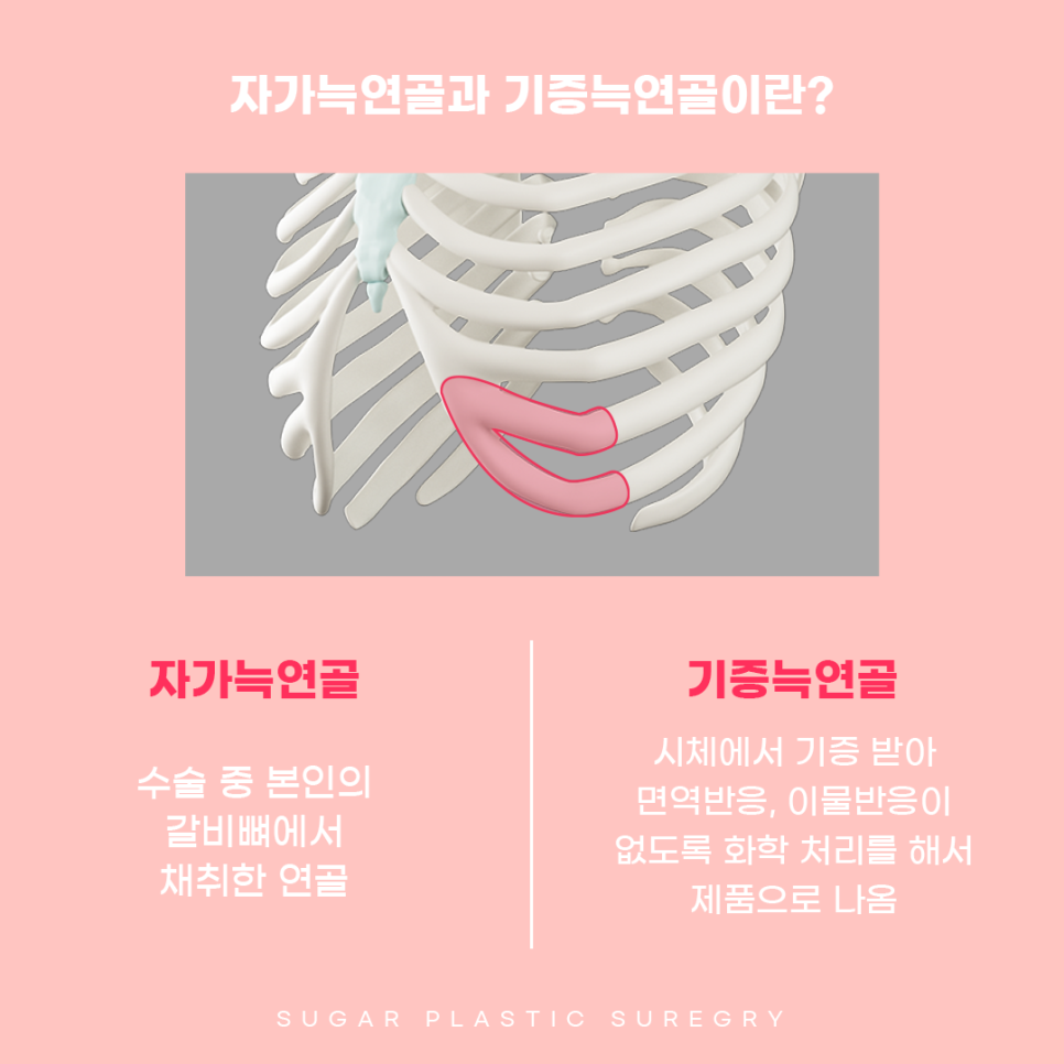 기증늑 자가늑 어떤게 좋을까? 관련 이미지 2