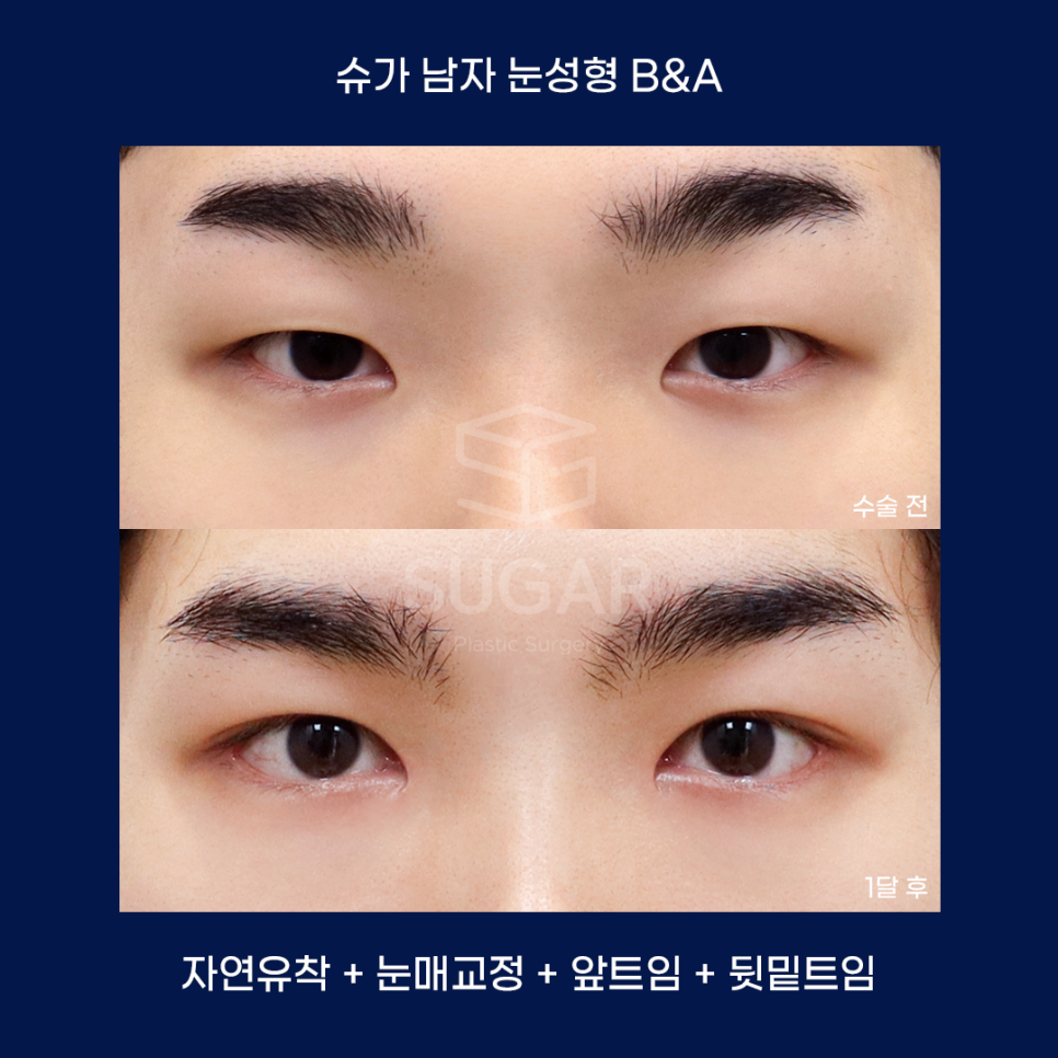 남자성형에 관한 궁금한 점 다 알려드립니다! 관련 이미지 12