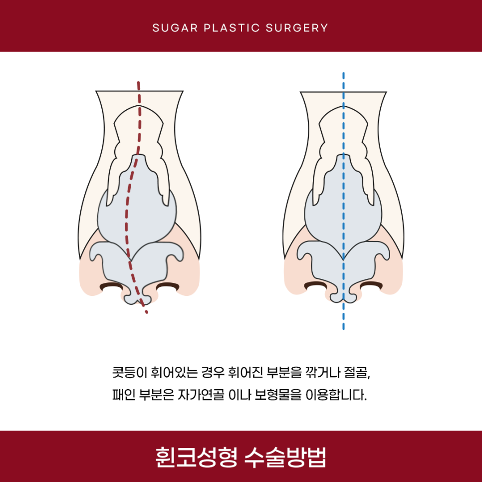휜코 성형 알아보고 있다면 관련 이미지 8