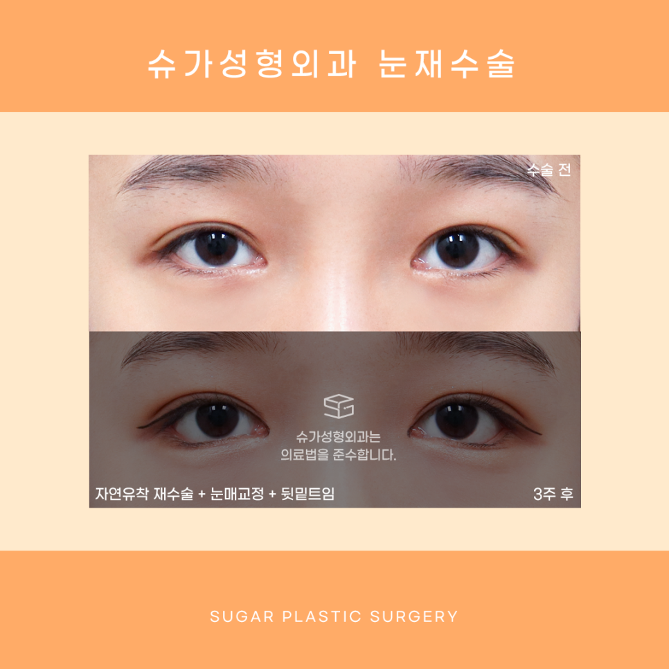 눈재수술 최대 몇 번까지 가능할까? 관련 이미지 5