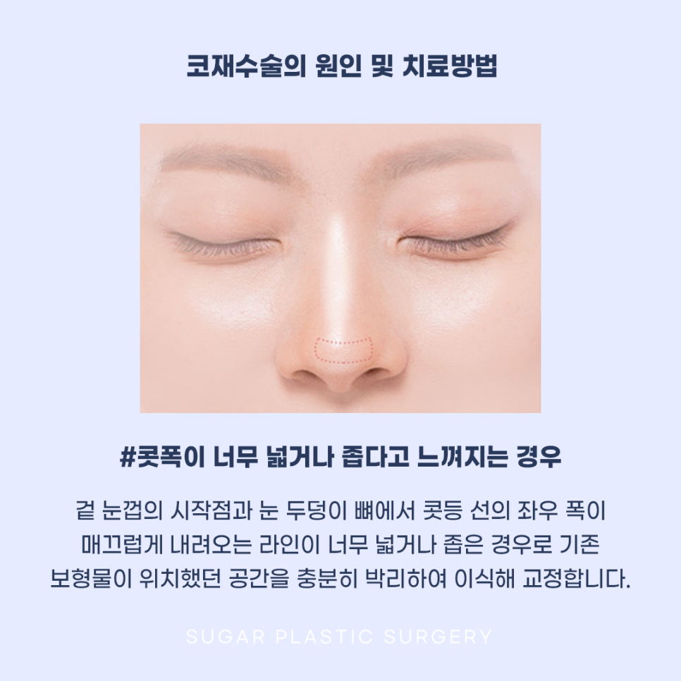코재수술 그 유형과 해결방법은? 관련 이미지 11