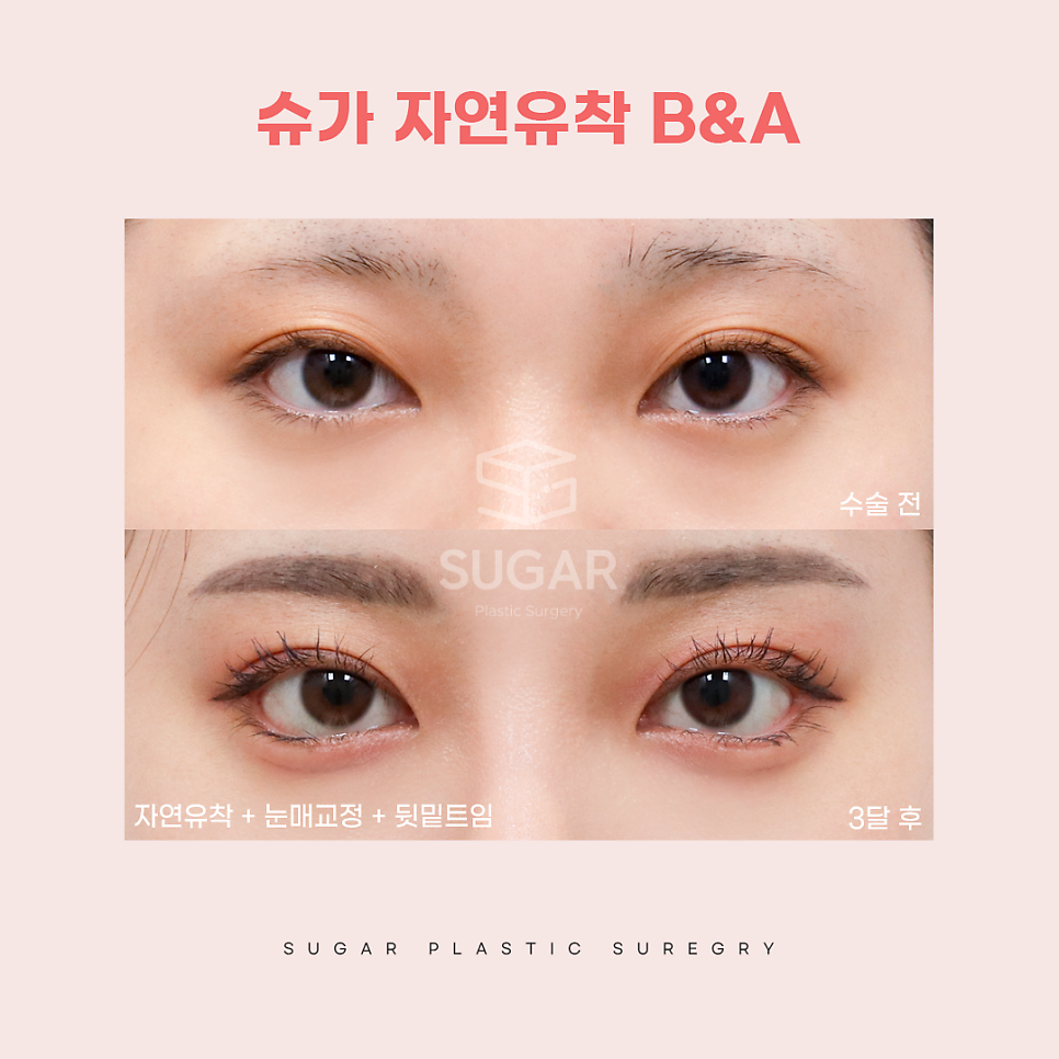 연예인쌍수라인으로 보는 쌍꺼풀라인 관련 이미지 8
