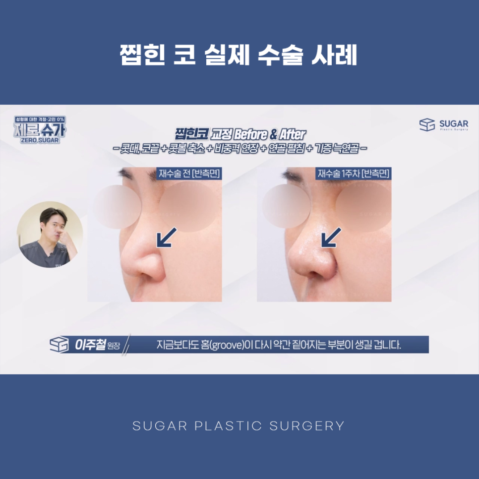 찝힌코 왜 생기는 걸까? 관련 이미지 14