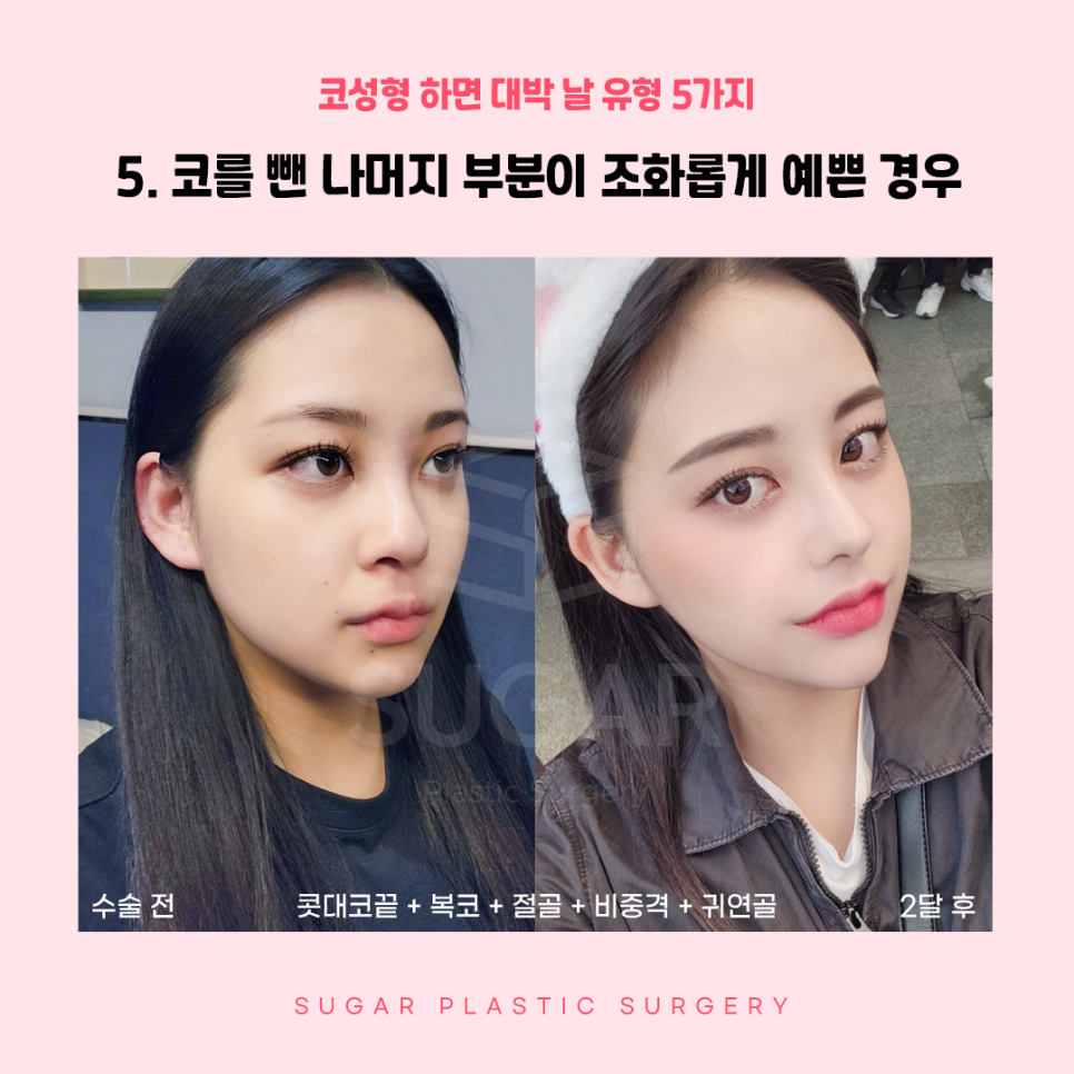 코성형 대박나는 코 관련 이미지 11