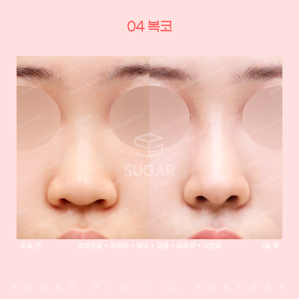 코 유형에 따른 코성형 방법 관련 이미지 15