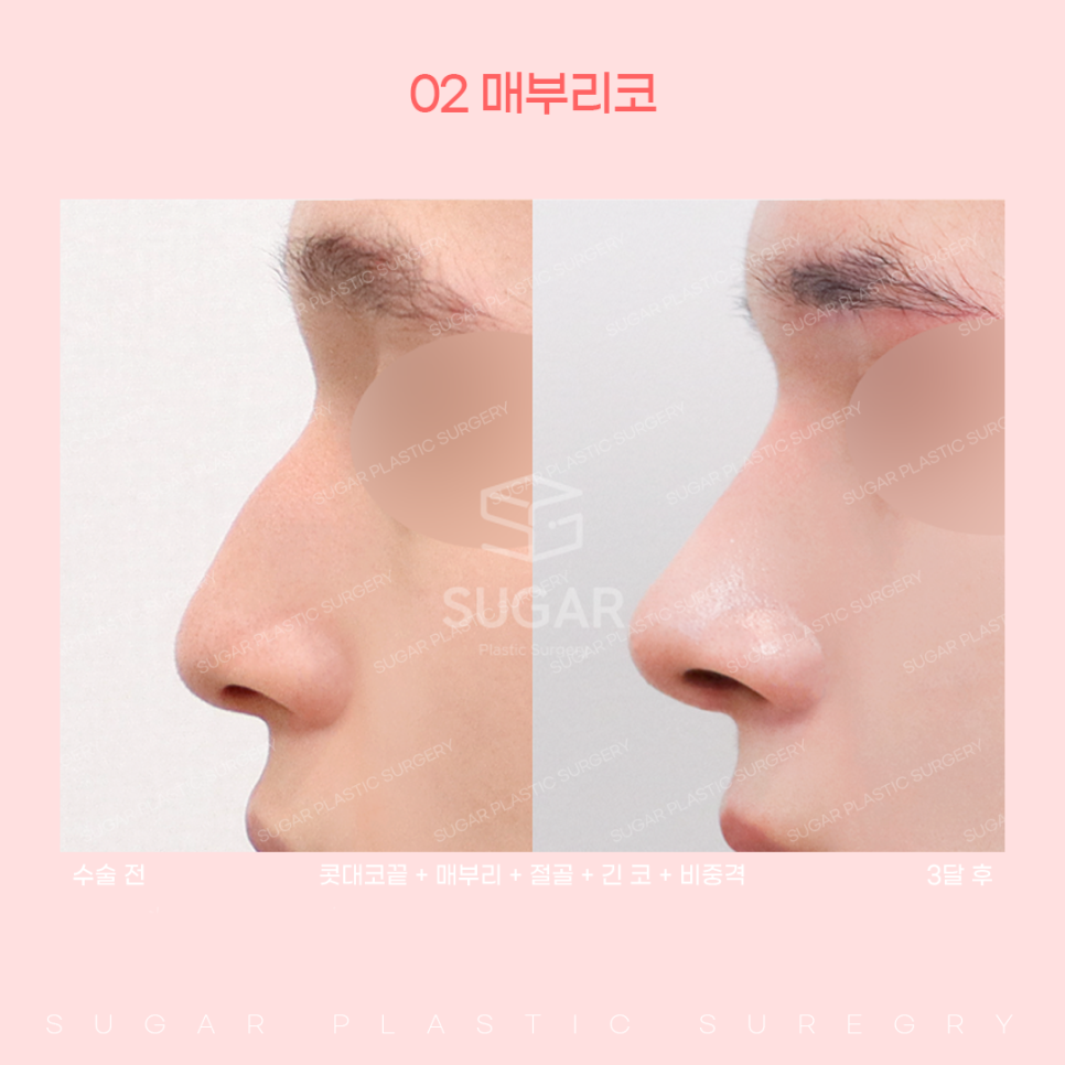 코 유형에 따른 코성형 방법 관련 이미지 11