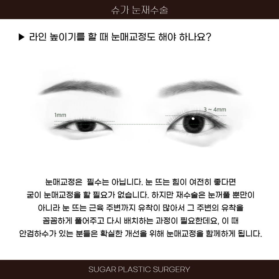 라인높이기 눈재수술 이것만은 알고가자 관련 이미지 8