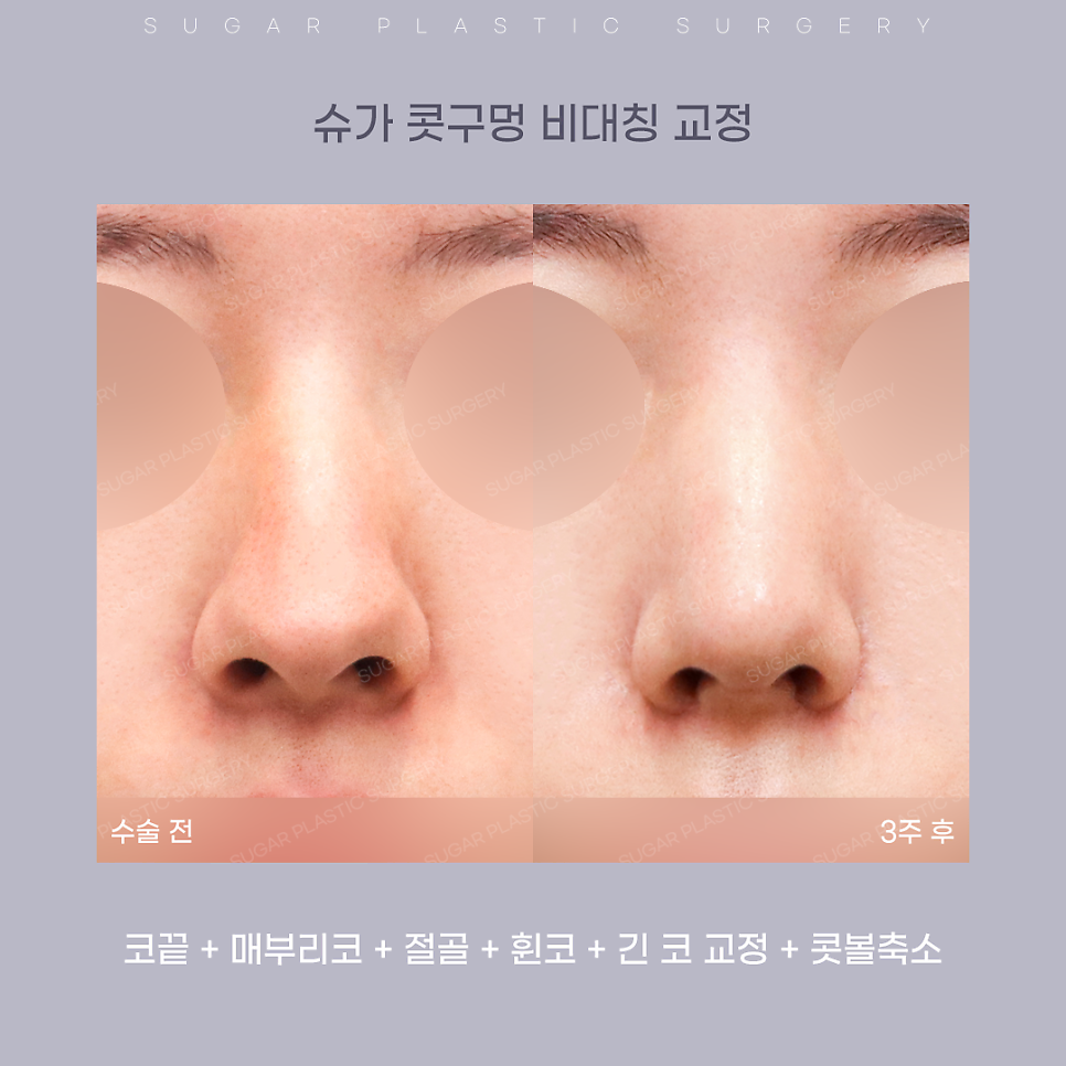 코 성형 후 콧구멍 짝짝이가 되었다?! 관련 이미지 5
