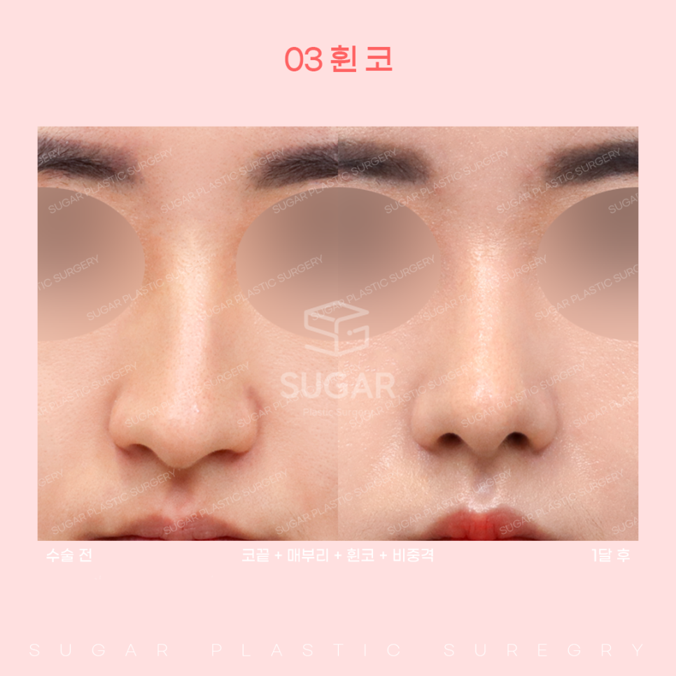 코 유형에 따른 코성형 방법 관련 이미지 12