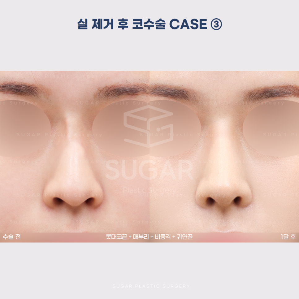 [슈가성형외과] 이런 코시술 하지마세요 관련 이미지 14