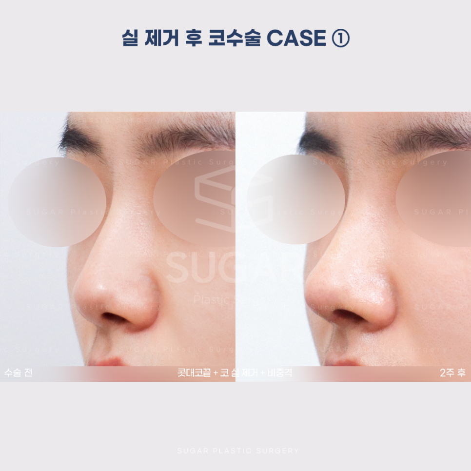 [슈가성형외과] 이런 코시술 하지마세요 관련 이미지 6