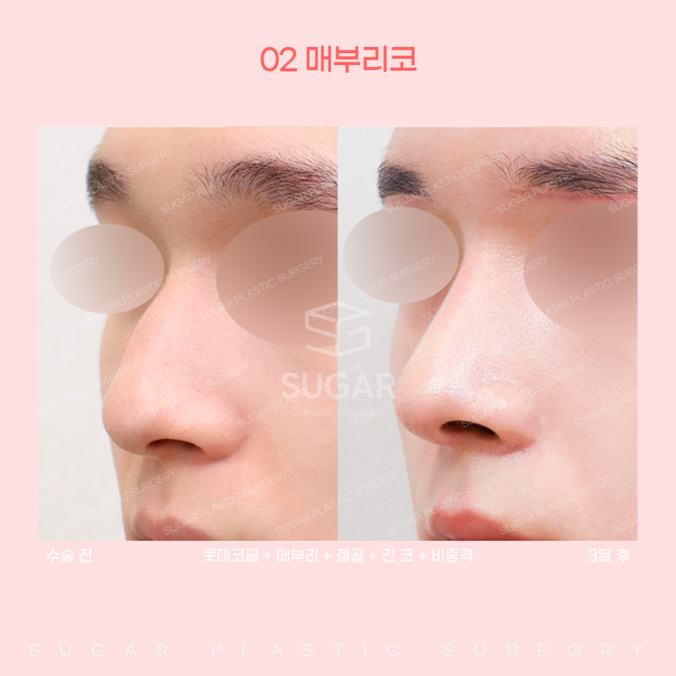 코 유형에 따른 코성형 방법 관련 이미지 10