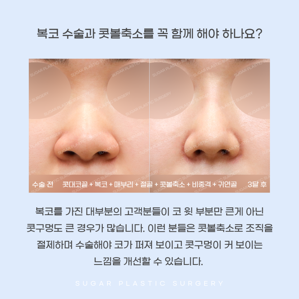 콧볼축소와 코끝성형을 같이 하는 이유는? 관련 이미지 6
