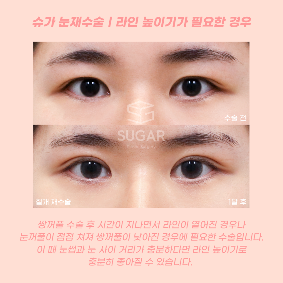 눈재수술 라인높이는 방법 관련 이미지 2