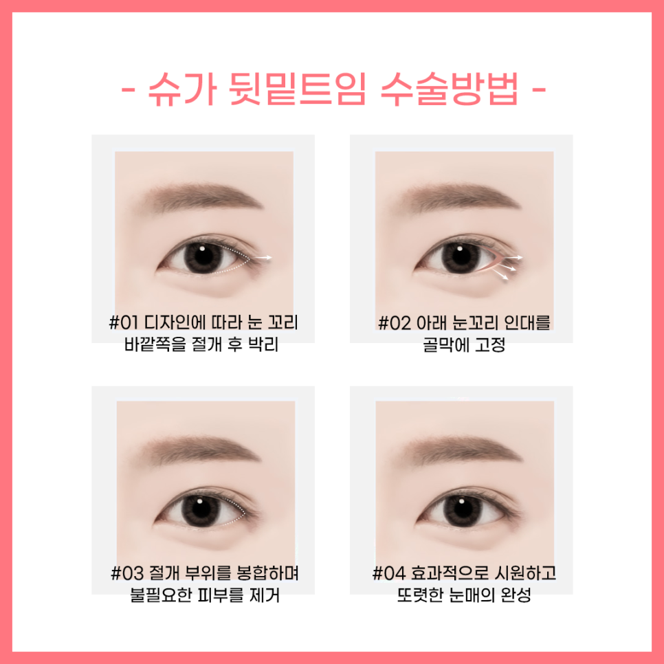 뒷밑트임 붙을까봐 걱정이라면? 관련 이미지 5