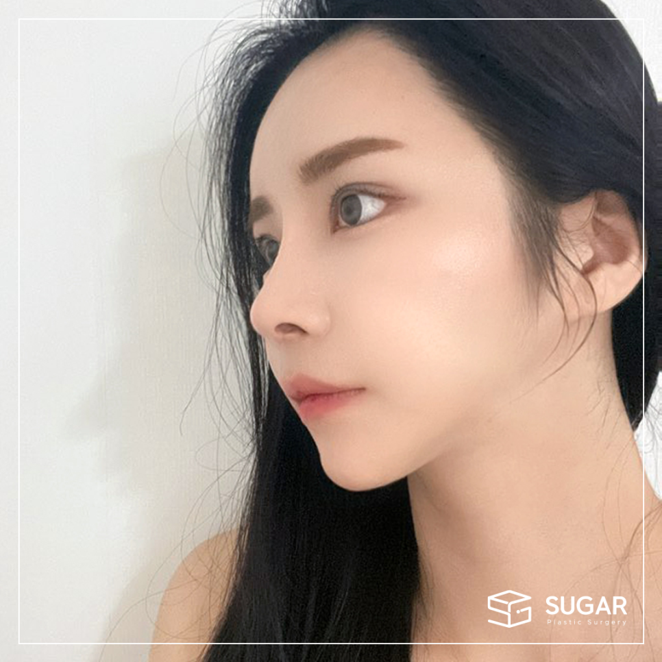 콧볼축소와 코끝성형을 같이 하는 이유는? 관련 이미지 3