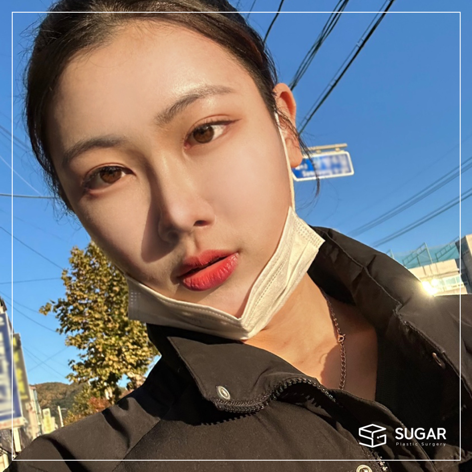 비절개눈매교정 VS 절개눈매교정 관련 이미지 12