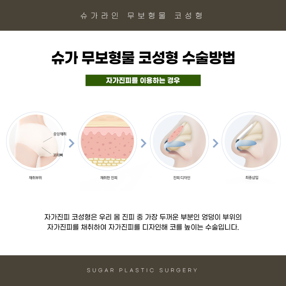 무보형물 코수술 슈가성형외과 관련 이미지 6