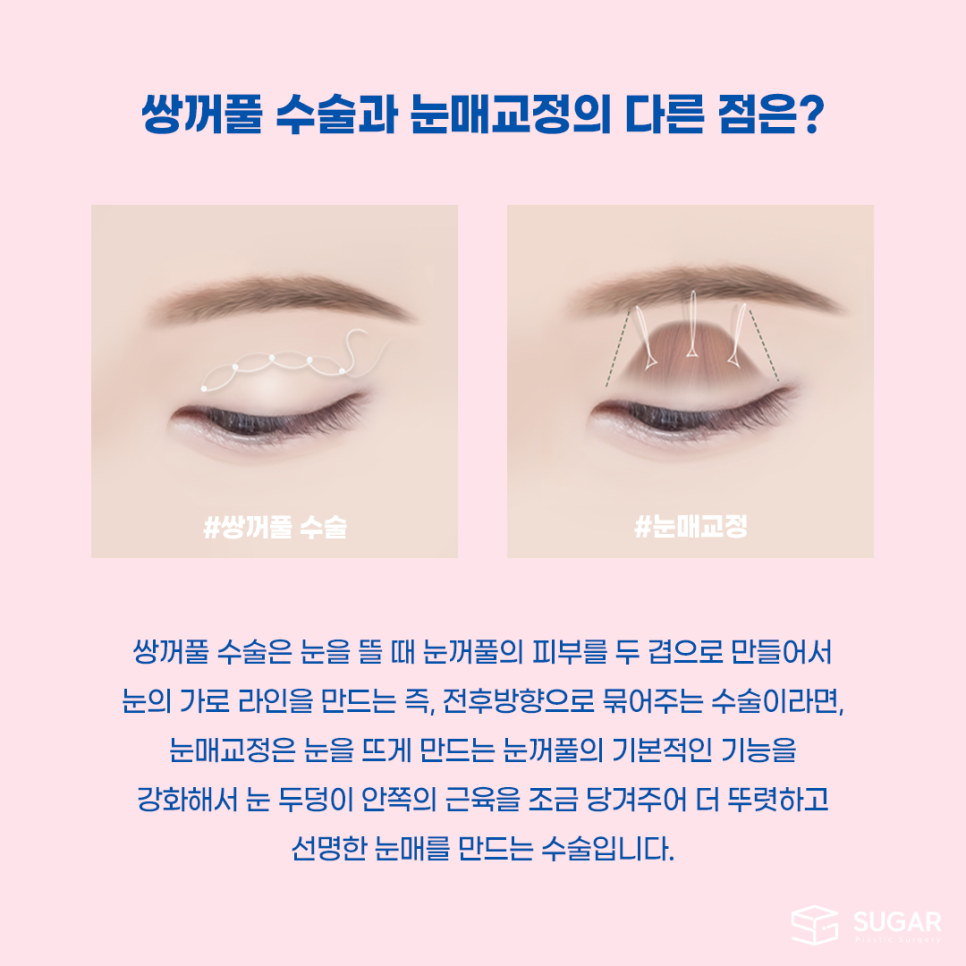 비절개눈매교정 VS 절개눈매교정 관련 이미지 4